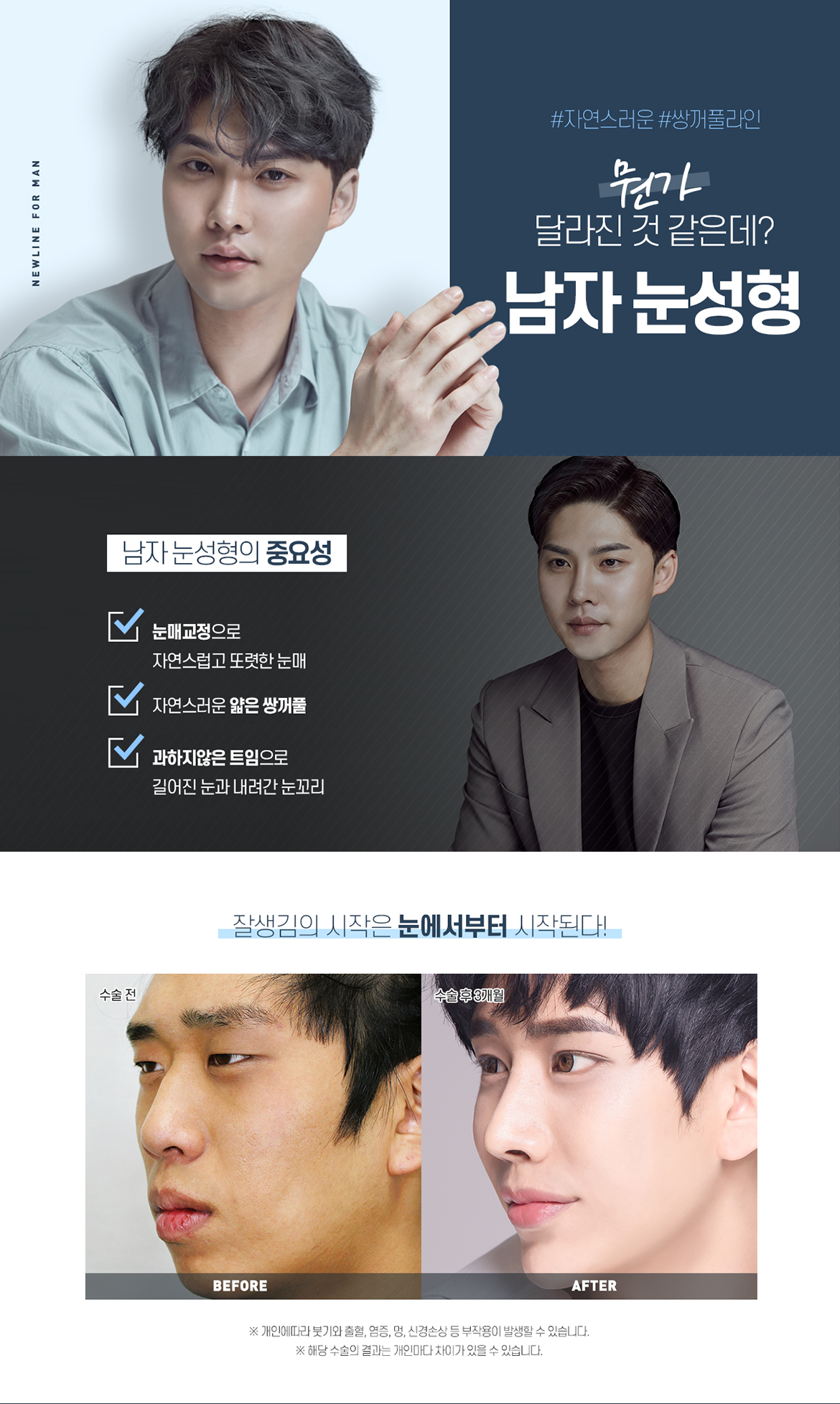 뉴라인 남자눈성형