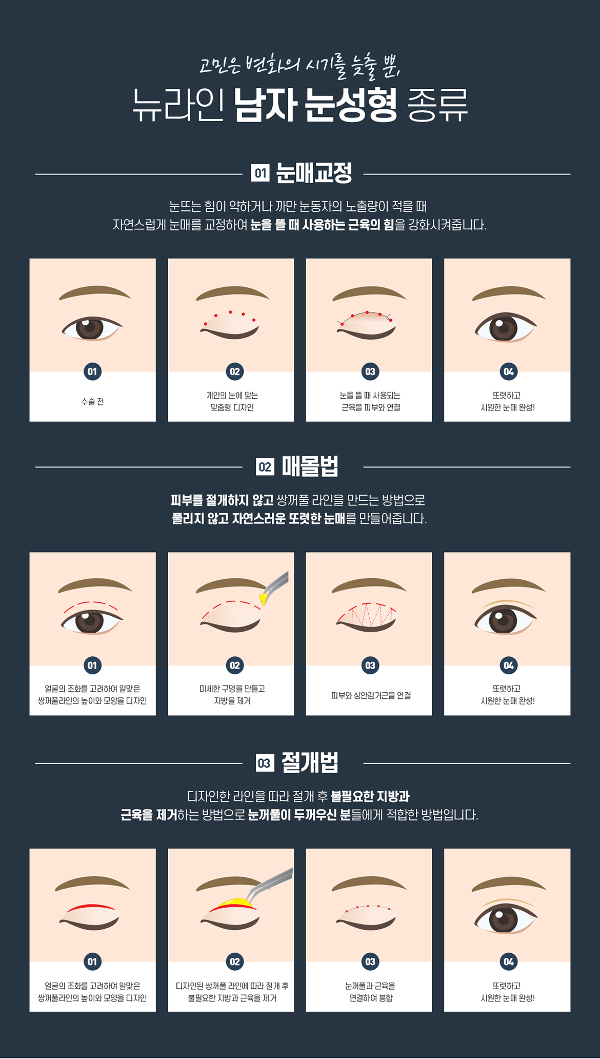 뉴라인 남자눈성형