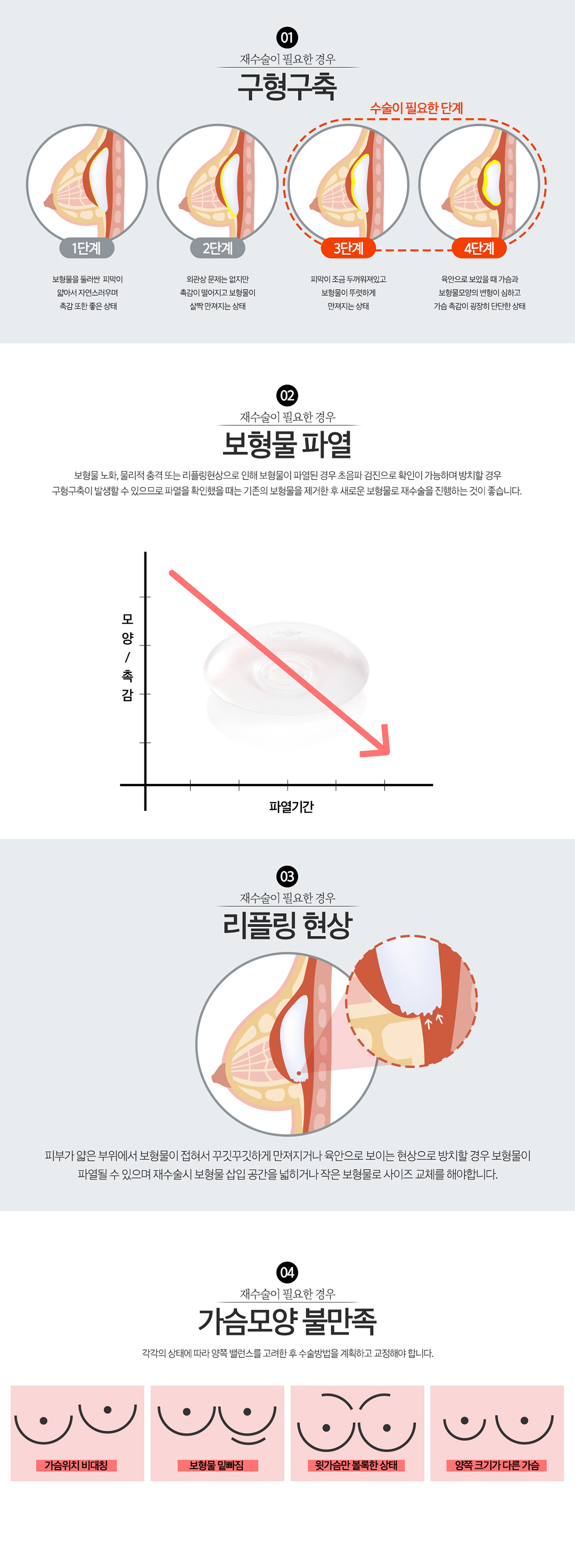뉴라인 가슴재수술