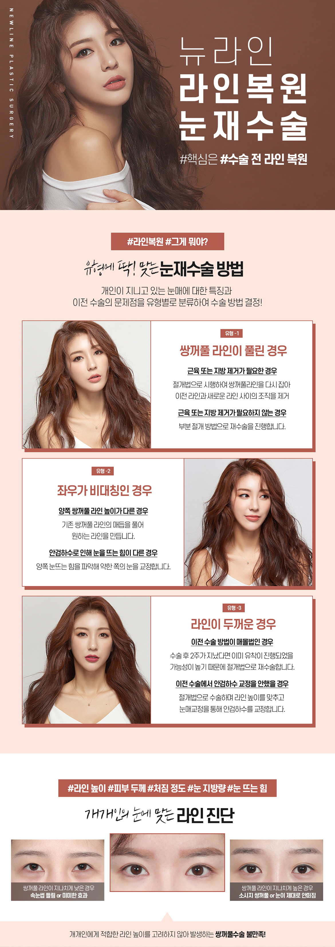 눈재수술