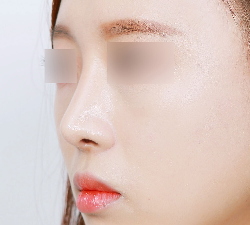 NoseSurgery after 2