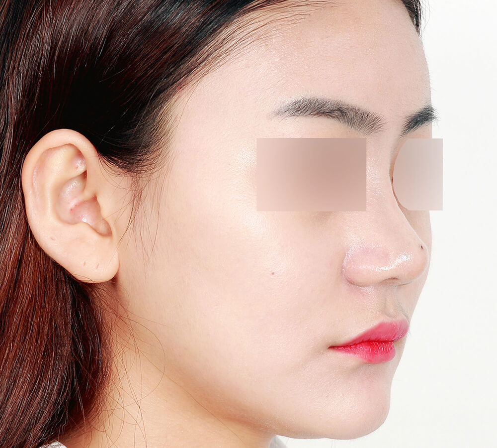 NoseSurgery after 4