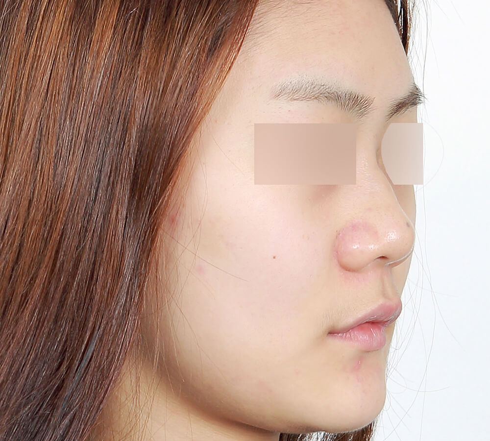 NoseSurgery before 4