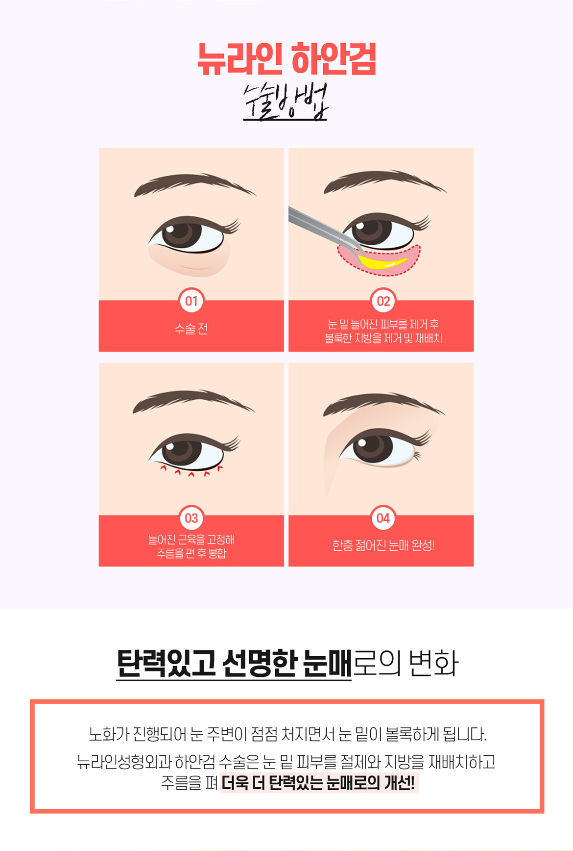 하안검